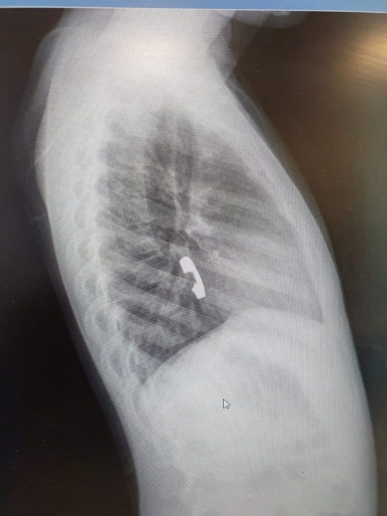 בת ה-6 מצאה טבעת בגן - הרופאים שלפו אותה מגרונה • תיעוד