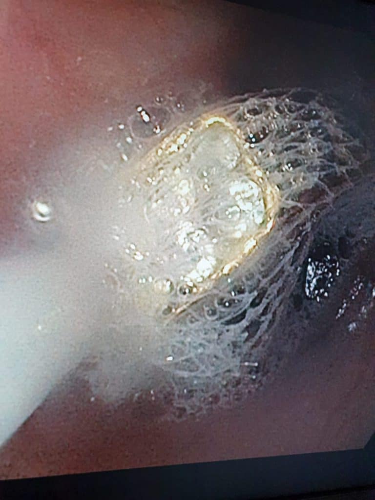 בת ה-6 מצאה טבעת בגן - הרופאים שלפו אותה מגרונה • תיעוד