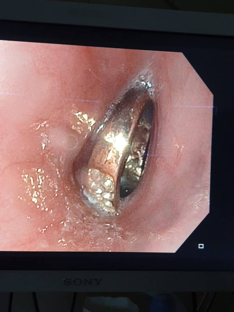 בת ה-6 מצאה טבעת בגן - הרופאים שלפו אותה מגרונה • תיעוד