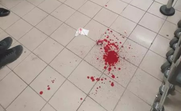 תיעוד מתוצאות האנטישמיות: חסיד ברסלב הוכה עד זום דם תיעוד מתוצאות האנטישמיות: חסיד ברסלב הוכה עד זום דם