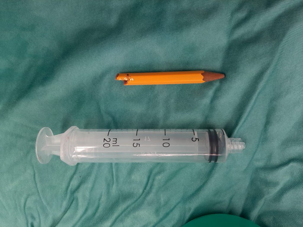 עיפרון באורך 7 ס'מ הוצא מרגלו של ילד בן 10