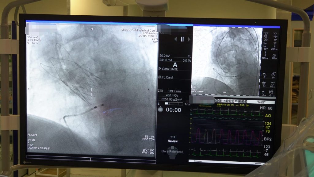 לראשונה בישראל: השתלה ללא התערבות כירורגית