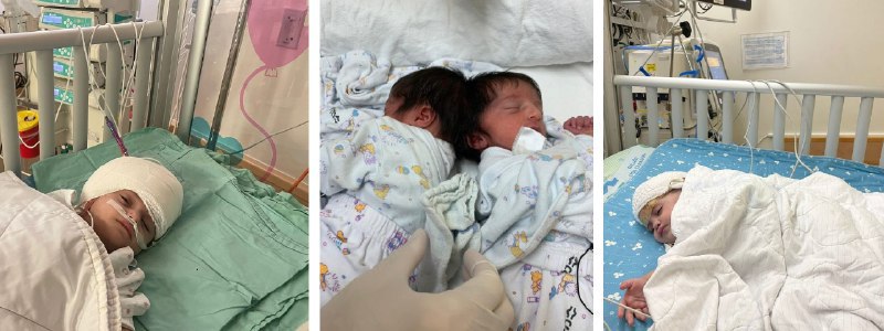 לראשונה בישראל: ניתוח נדיר להפרדת תאומות המחוברות בראשן