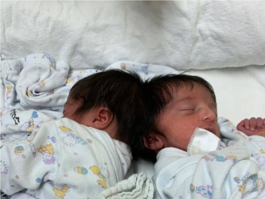 לראשונה בישראל: ניתוח נדיר להפרדת תאומות המחוברות בראשן