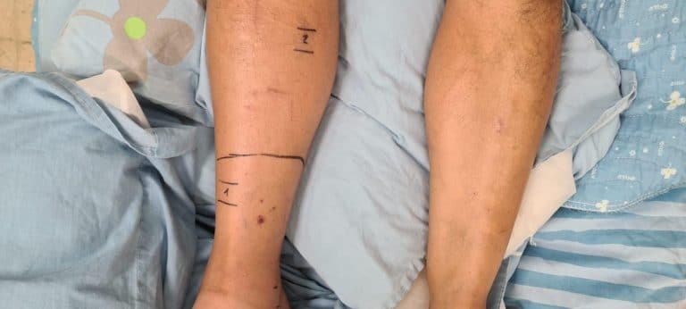 חקלאי הוכש על ידי נחש – שכנתו הרופאה הצילה את חייו