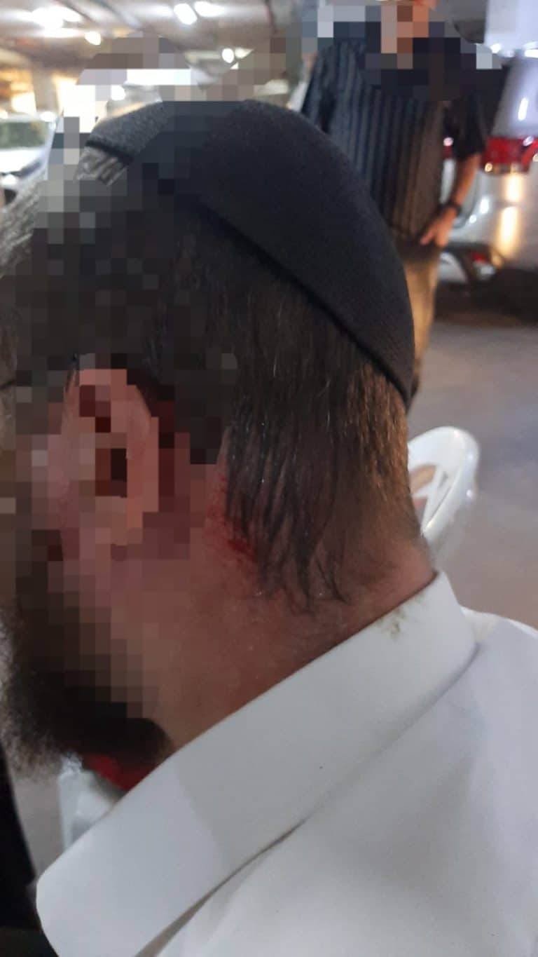 מעלה הזיתים: יהודי נפצע קל לאחר שרכבו נרגם באבנים