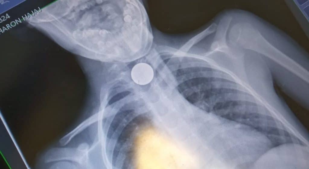 בן 7 ניצל לאחר שנחנק ממטבע כסף