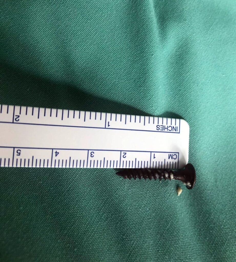 בבית חולים פדה-פוריה חילצו בורג מבטנו של פעוט